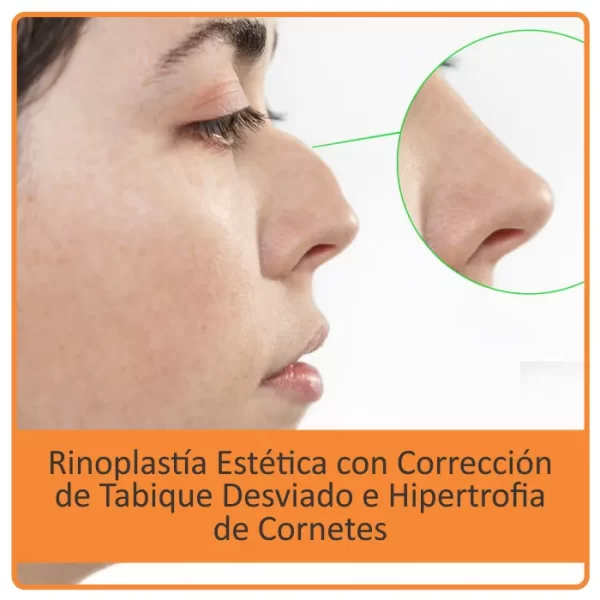 Rinoplastía Estética portada