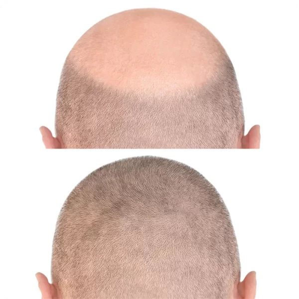 trasplante de pelo con tecnica fue02@riomedic&egospa