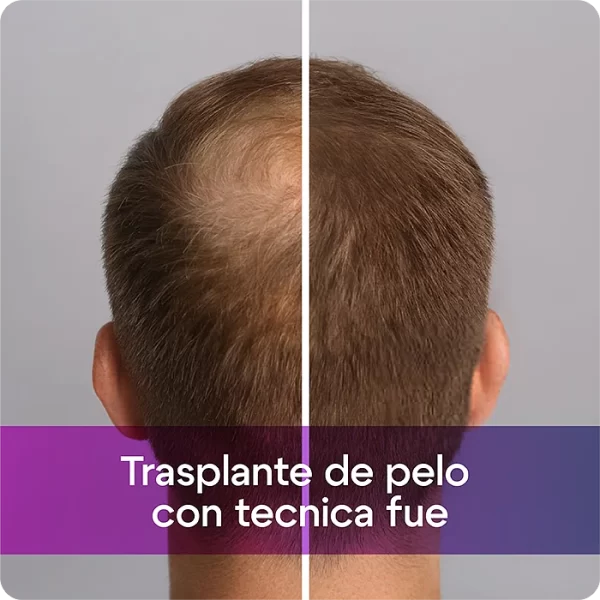 trasplante de pelo con tecnica fue@riomedic&egospa