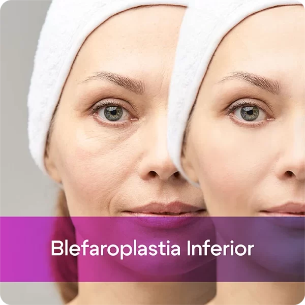 Blefaroplastia Inferior