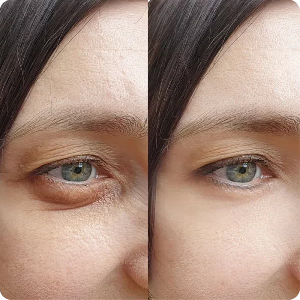 Blefaroplastia Inferior01