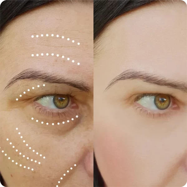 Blefaroplastia Superior