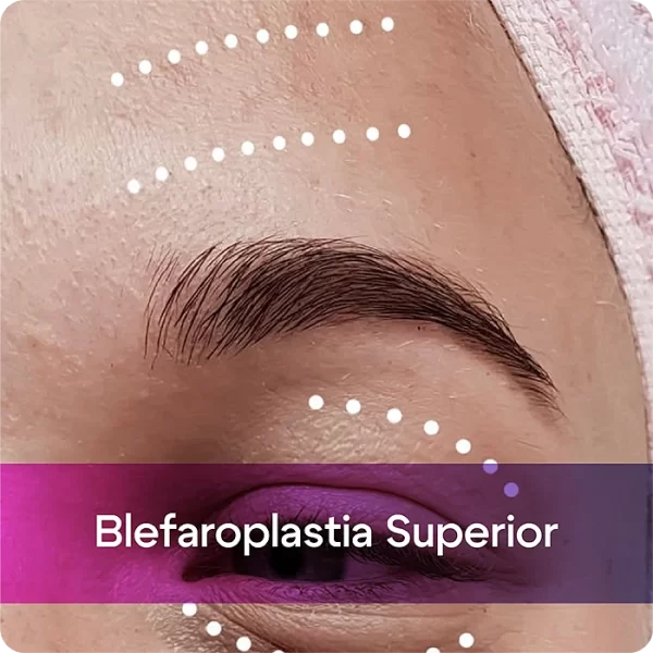 Blefaroplastia superior0