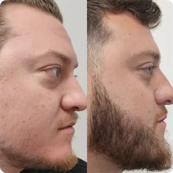 Implantes de barba y bigote02@riomedic&egospa