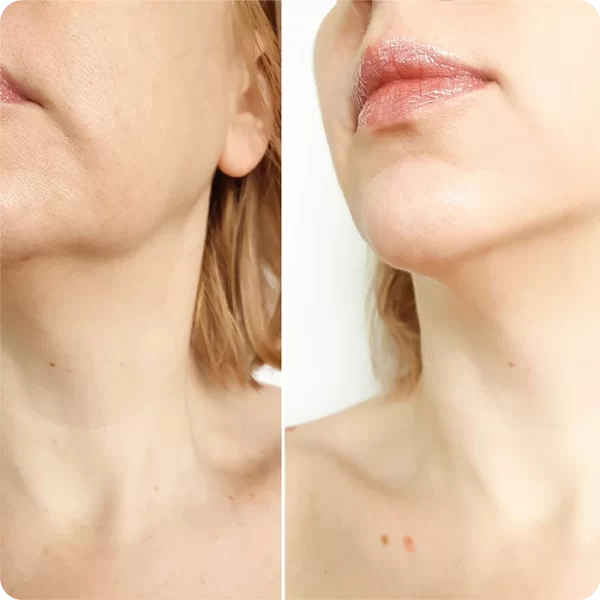Lipo-transferencia malar0