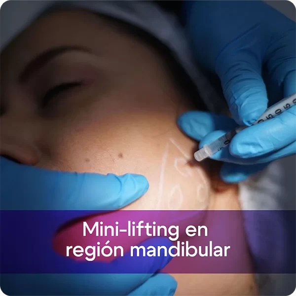 Mini-lifting en región mandibular