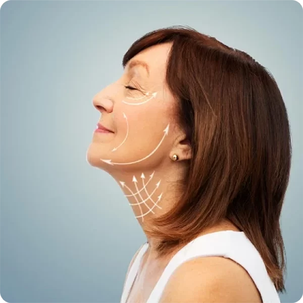 Mini lifting en región mandibular0