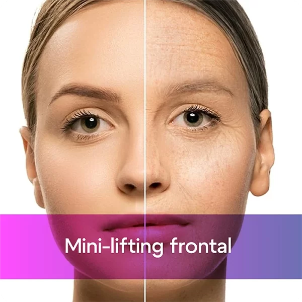 Mini-lifting frontal0