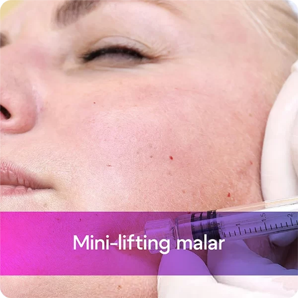Mini-lifting malar