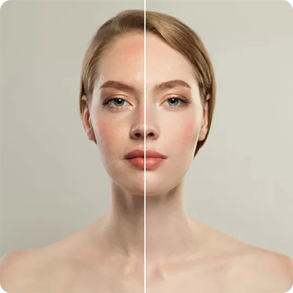 minilifting-facial0