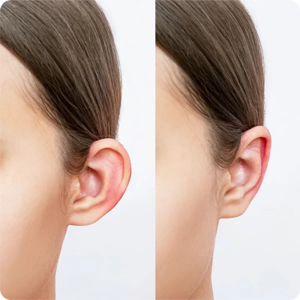 otoplastia2@riomedic&egospa